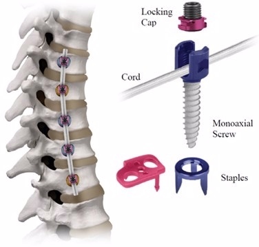 REFLECT Scoliosis Correction System – H210002