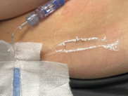 Photo showing white powder was found under the tape around the elastomeric pump sensor of a patient.