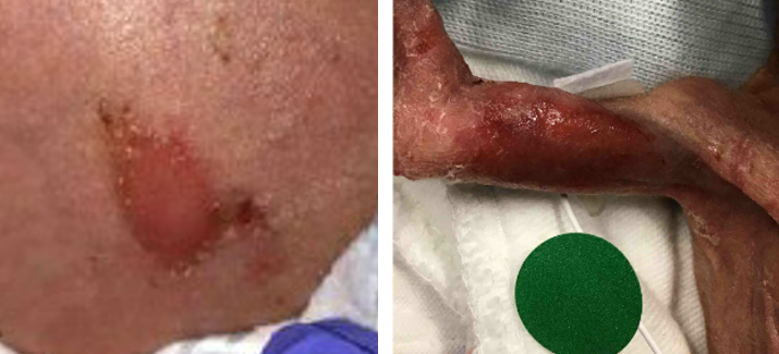 Left photo: Abdominal burn/wound; Right photo: Underside of left upper arm showing burn/redness.