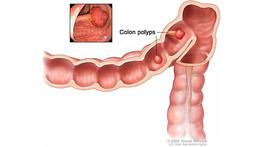 Colon-polyps illustration_725