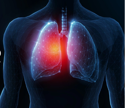 Lung Cancer