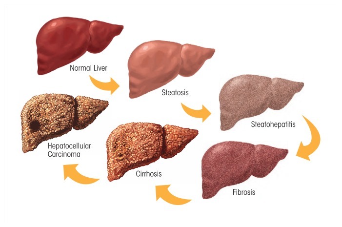 Alcoholic Liver Disease: Pathogenesis and Current Management