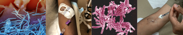 Collage of RSV particles, Ebola treatment, M. tuberculosis bacteria and eczema treatment