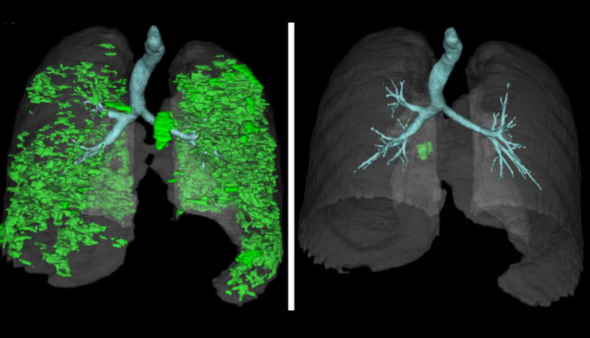 3D-reconstructed chest CT images of a person with APECED pneumonitis before and one month after starting treatment. 