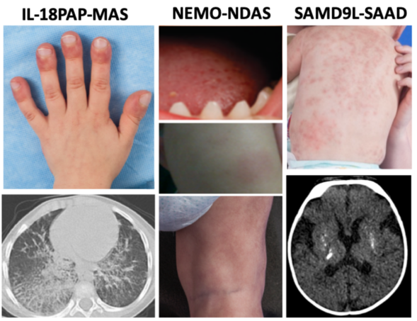 A photo collage of clinical symptoms of three new autoinflammatory diseases discovered by NIAID scientists and colleagues.