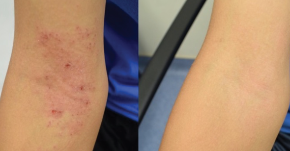 Left panel shows inner elbow covered with red rash and right panel shows inner elbow with clear skin