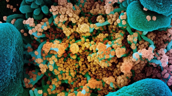 Scanning electron micrograph of a dying cell heavily infected with SARS-CoV-2