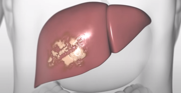 Illustration of a liver with cirrhosis 