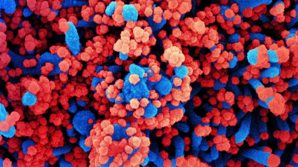 Colorized scanning electron micrograph of human cell infected with SARS-CoV-2