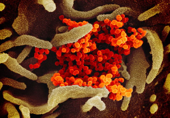 Scanning electron micrograph of SARS-CoV-2 shedding from a human cell