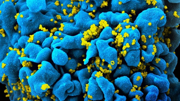 Scanning electron micrograph of HIV particles emerging from an infected T cell