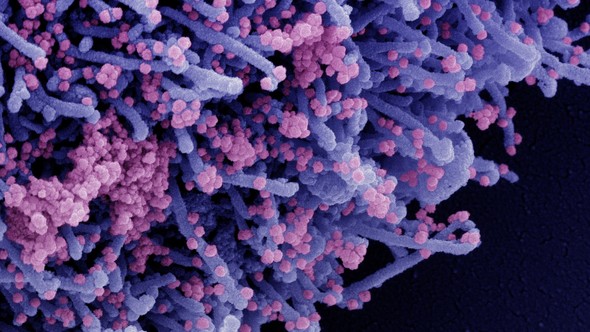 SEM image of cell infected with SARS-CoV-2