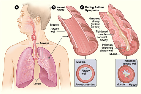 Illustration of airways in people with asthma