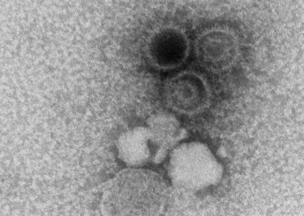 An electron microscopy image showing three Epstein-Barr virions