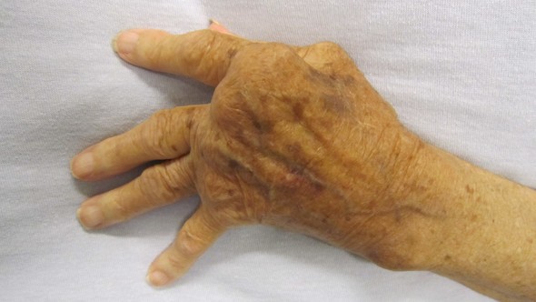 Photo of a hand affected by rheumatoid arthritis