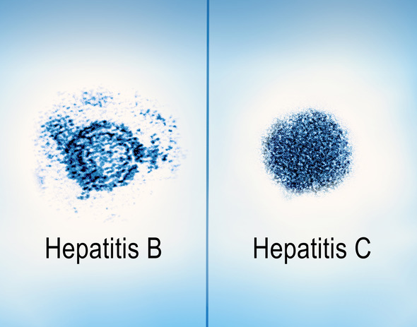 Two spheres made of clustered dots, one labeled hepatitis B and one labeled hepatitis C, separated by a line. 