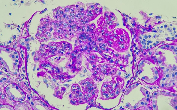 Microscopic image showing lupus nephritis in kidney tissue. Large, round, pink shapes and smaller, round, purple shapes on a white background.