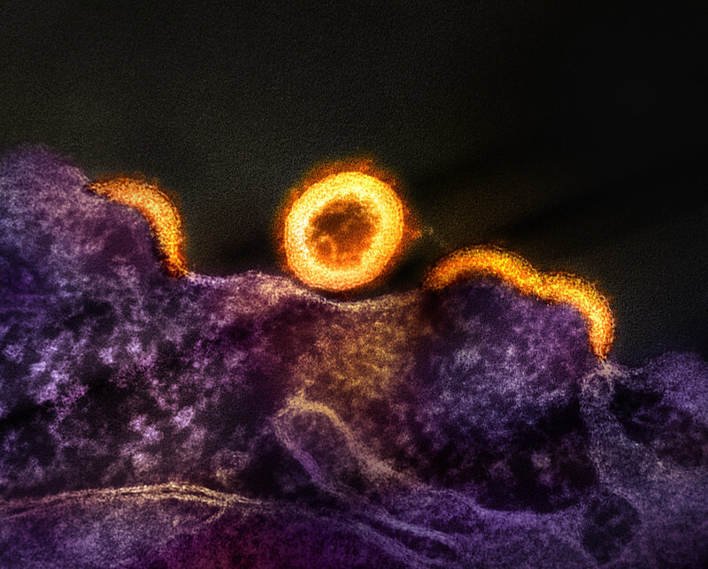 Microscopy of a purple, splotched T cell with circular and semi-circular gold-colored HIV virus particles appended to it on a black background. 