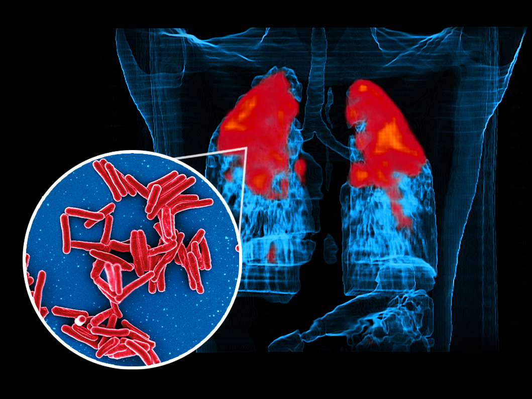 Torso outlined in blue containing lungs with blue and red sections on black background, inset with image of red rod-shaped bacteria on blue background