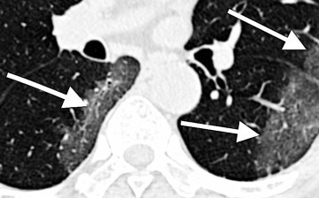 CT image of lungs