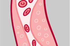 Blood vessel with plaque buildup