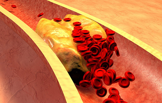 An illustration of a blood vessel with plaque buildup.