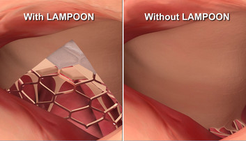 The LAMPOON technique splits the heart valve leaflet (left) so that it doesn't block blood flow (right). 