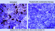 HIV-CRISPR-Laser ART