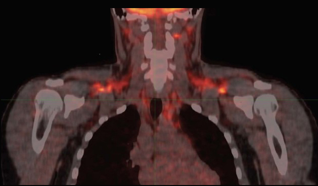 Image of brown fat activation