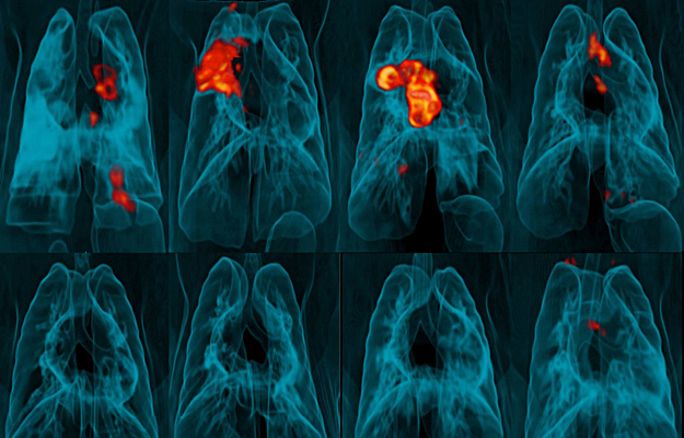 An image of PET-CT lung scans.
