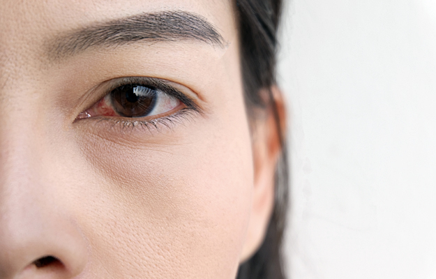 A closeup of a woman's red eye.
