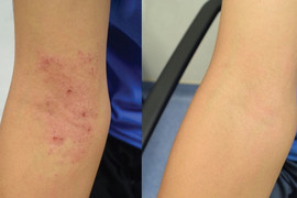 Elbow with eczema before and after treatment