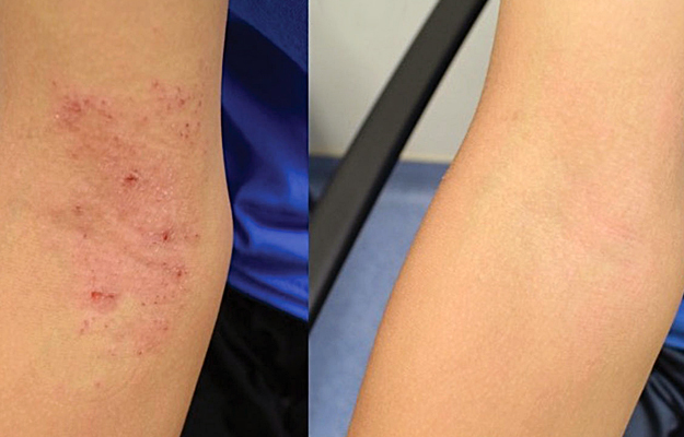 The inner elbow of a child with eczema before Roseomonas mucosa therapy (left) and after four months of treatment (right).