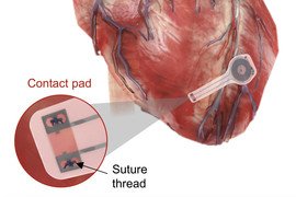 Temporary pacemaker mounted on the heart