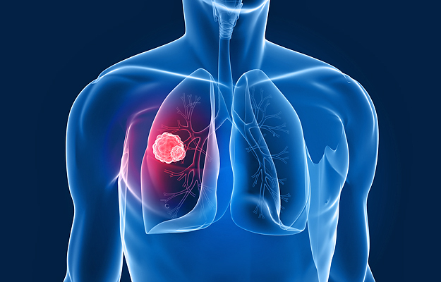 An illustration of a lung cancer tumor.