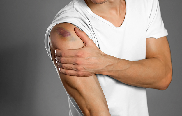 A man holding his bruised shoulder.