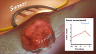 Wearable Tumor Sensor