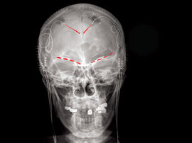 X-ray shows human head with electrodes at the top of the brain and above the eye sockets.