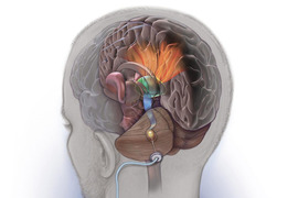 Illustration showing a lead implanted in the lower rear of the brain and stimulating nerves that connect to other brain regions.