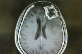 MRI of a gliblastoma.