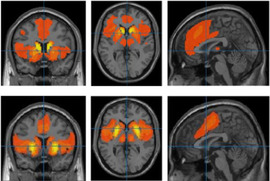 Brain images with red and yellow areas.