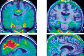 Four tau PET brain images show larger areas of red in left two images