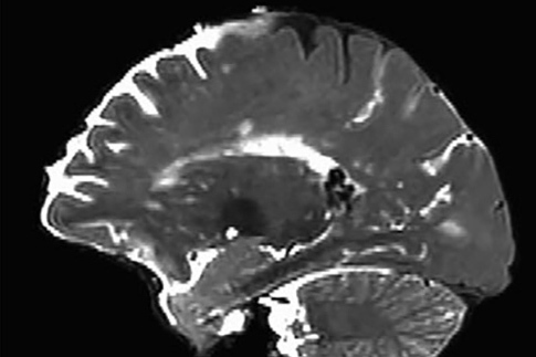 Side view showing perivascular spaces highlighted throughout a human brain.