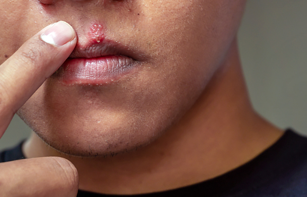 A close-up of a man pointing to a fever blister on his mouth.