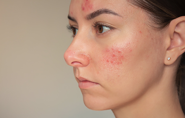 A close-up of a woman with rosacea on her cheek and forehead.