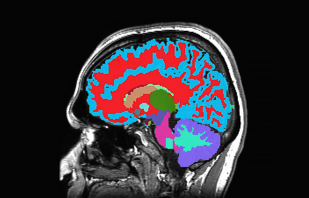 A magnetic resonance imaging (MRI) brain scan.
