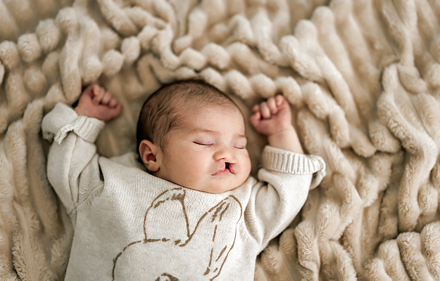 A baby with a cleft lip lying on its back on a blanket.
