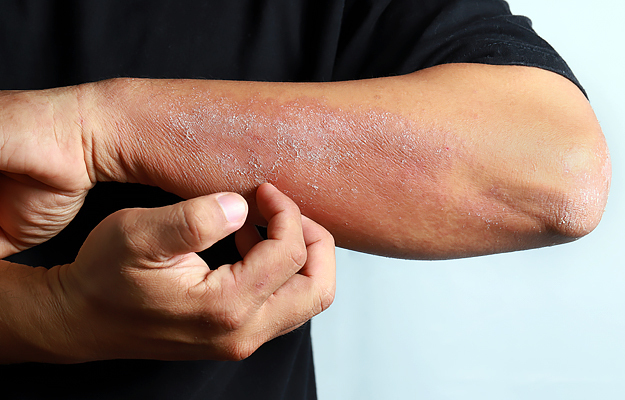 A close-up of a man's forearm with atopic dermatitis (eczema).