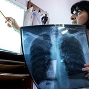 Treatment for drug-resistant TB still effective with lower dosage and less side effects 