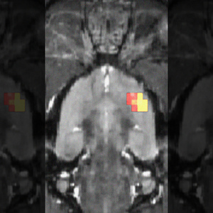 Brain scan - Brain regions showing less opioid receptor availability. Scott J. Thompson